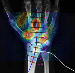東京医科歯科大学・金沢工業大学・リコー、「脊磁計」を用いた腰部・頚部・末梢神経の生体磁界計測に成功