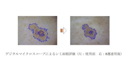 ヘパリン類似物質、プラセンタエキス併用時の有用性について日本美容皮膚科学会にて発表