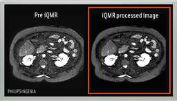 国内初・MRI画像のノイズ低減ソフトウェア「iQMR」販売開始 