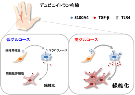 糖尿病患者に多いデュピュイトラン拘縮の新たな線維化メカニズムを解明