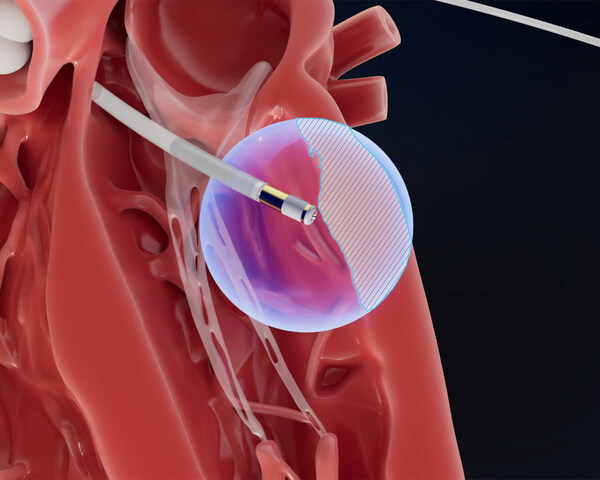 FIELD MEDICAL社、「HEART RHYTHM 2025」で瘢痕性VTにおける局所 FIELD MEDICAL社、「HEART RHYTHM 2025」で瘢痕性VTにおける局所